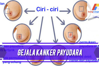 Gejala Kanker Payud*ra yang Bisa Dilihat Langsung