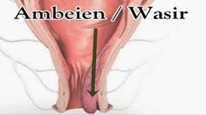 Ambeien