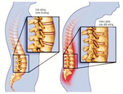 Thế nào là viêm cột sống dính khớp