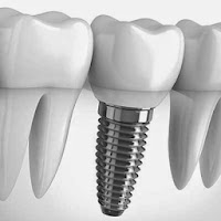 http://www.dental-clinic-delhi.com/dental-implants.html