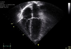 Echocardiogram_4chambers