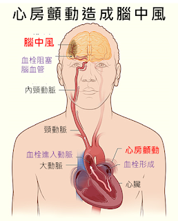 心悸與心房顫動造成腦中風