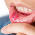 Home Remedies for Canker Sore on Tongue