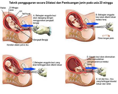 Terkini Pengguguran Bayi