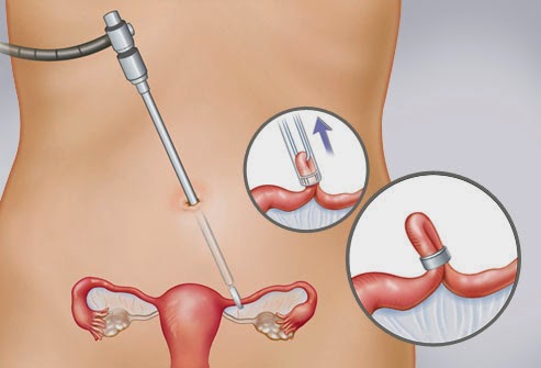 120 Method of birth control | Biology Notes for IGCSE 2014