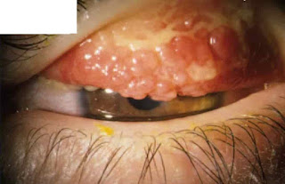 Short cases in ophthalmology