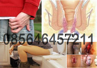 Harga Obat Wasir di Apotik Herbal