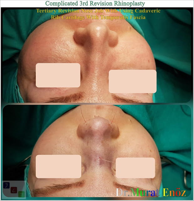 Complicated 3rd Revision Rhinoplasty - Tertiary Revision Nose Job With Using Cadaveric Rib Cartilage With Temporalis Fascia