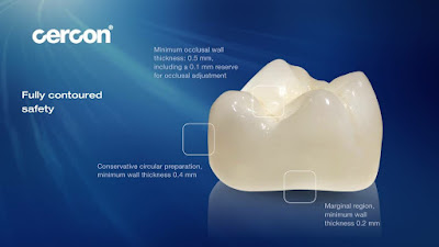 Giá răng sứ cercon zirconia bao nhiêu? 