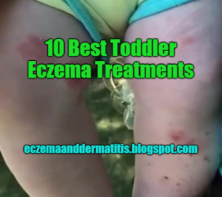 10 Best Toddler Eczema Treatments