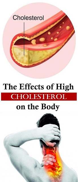 The Effects of High Cholesterol on the Body