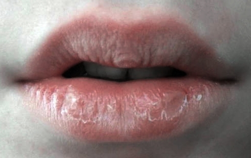 Merah Cekelat: Ikhtiar Memulihkan Bibir Kering