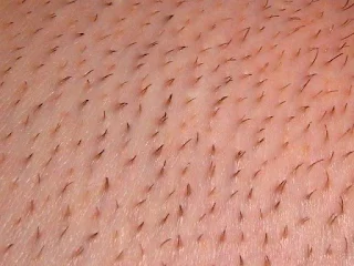 ما هو جلد الوزة وعلاجه، جلد الدجاجة في الساقين واحتباس الشعر تحت الجلد