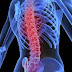 Nursing Care Plan for Osteoporosis