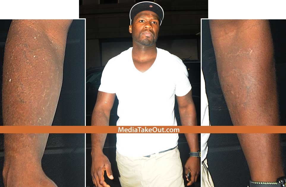 50 Cent had all the tattoos on his arm removed