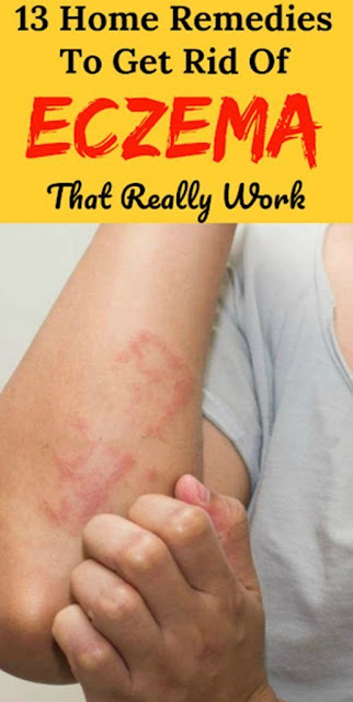 13 Home Remedies To Get Rid Of Eczema Fast That Really Work