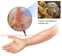 Obat Scabies Untuk Manusia