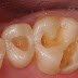 Răng cấm bị mẻ có ảnh hưởng gì không?