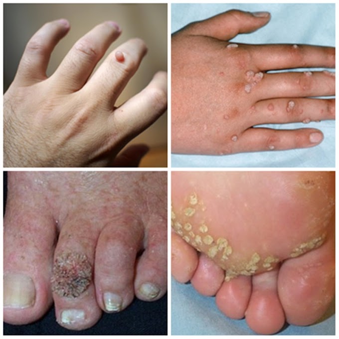 Top herbs for treatment of all types of Warts.