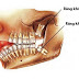 Những lưu ý khi nhổ răng số 8