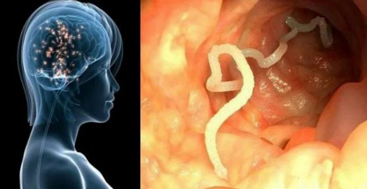 If You Eat These Common Foods You Have A High Chance Of Having Worms In The Brain