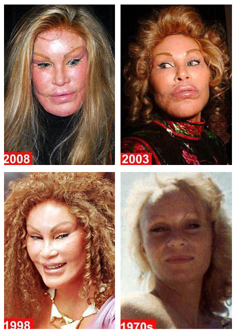 fergie plastic surgery before and after. Cat Woman Plastic Surgery