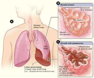 Even Health Care Professionals would like a pneumonia Plan!