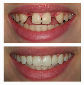 Dental implants, bellevue dental care