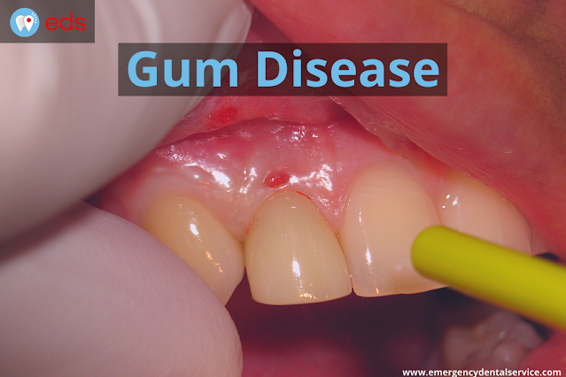 Gum Disease - Emergency Dental Service