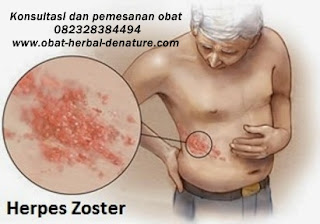 obat herpes kelamin,obat herpes zoster,obat cacar dompo,obat cacar air,obat herpes kemaluan,obat herpes tangan,obat herpes bibir,obat herpes badan