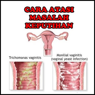 Obat Keputihan Karena Jamur di Apotik