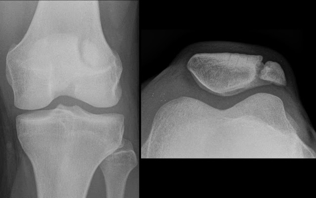 Kneecap Fracture Treatment | Kneecap Bone Fracture Surgery