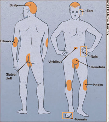 Las zonas del cuerpo donde es más propensa a aparecer la psoriasis