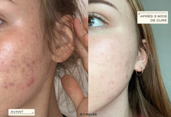 Fighting Hormonal Acne: Expert Tips for Treatment and Prevention