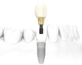 Trồng răng implant giá rẻ nhất là bao nhiêu ?