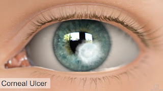 Common eye problems occurs in rainy season, treatment and prevention tips, Corneal Ulcer