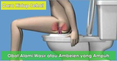 Obat Alami Wasir atau Ambeien yang Ampuh