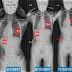 脊椎側彎矯正案例25-4個月腰椎側彎25度~8度