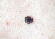 What are the 4 signs of melanoma? - melanoma symptoms -