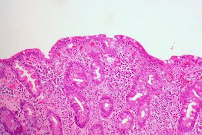 Celiac Sprue, Small Bowel Biopsy