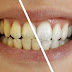 9 Astounding Approaches to More white Teeth 