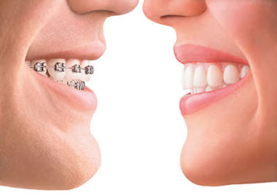 Niềng răng clear aligner