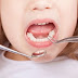 Răng sữa bị sâu có nên nhổ?