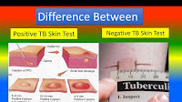 TB Test results