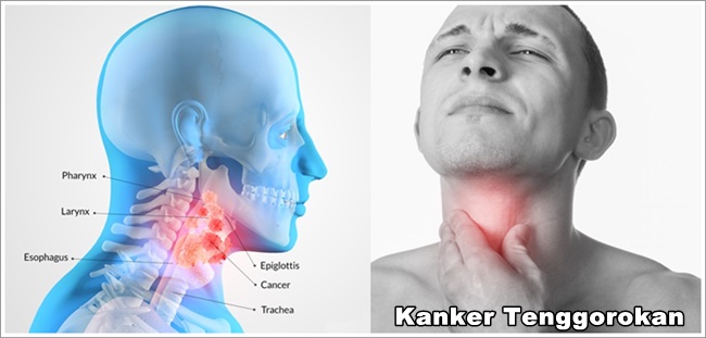 Obat Kanker Tenggorokan Stadium 3 (Recommended)