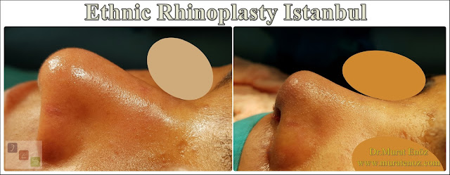 Ethnic Rhinoplasty Istanbul – Dr.Murat Enoz – Nose job in Istanbul – Nose surgery in Istanbul – Nose job in Turkey - Ethnic rhinoplasty Turkey - Ethnic rhinoplasty in Turkey - African American rhinoplasty - Ethnic expert nose job surgeon - Rhinoplasty surgeon in Istanbul - Black nose job - Rhinoplasty for ethnic nose - Rhinoplasty for African people - African American nose surgery – Rhinoplasty for African American Nose - Thick skin rhinoplasty - Rhinoplasty in istanbul