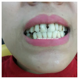 foto, gambar, gigi depan keropos Permata Dental Bali| sebelum dan sesudah gigi keropos diperbaiki di Permata Dental Bali | foto gigi keropos hitam Permata Dental Bali |gigi keropos karena sakit | gigi keropos berlubang | gigi keropos depan| gigi keropos bagian belakang | foto gigi keropos yang sudah diperbaiki Permata Dental Bali |  gigi keropos bagian depan| foto gigi keropos dan patah, foto gigi keropos oleh Permata Dental Bali, Bali Hits, Bali banget, area Bali, Bali kota, area kampus bali. veneer gigi keropos  Bali | veneer gigi keropos badung | veneer gigi keropos nusadua | veneer gigi keropos ngurahrai| veneer gigi keropos denpasar | veneer gigi kropos denpasar kota | veneer gigi keropos Bali | veneer gigi keropos gatsu | |veneer gigi keropos|  depan | veneer gigi keropos  atas | veneer gigi keropos  bawah | veneer gigi keropos  belakang |veneer gigi berlubang bali| veneer gigi berlubang Bali | veneer gigi berlubang nusadua| veneer gigi berlubang ngurahrai| veneer gigi berlubang Badung | veneer gigi berlubang depasar kota | veneer gigi berlubang denpasar| veneer gigi berlubang gatsu| veneer gigi berlubang jimbaran| veneer gigi berlubang bagus Permata Dental Bali | veneer gigi berlubang baik di Permata Dental Bali | veneer gigi berlubang cepat di Permata Dental Bali | veneer gigi berlubang murah di Permata Dental Bali | veneer gigi berlubang aman | veneer gigi berlubang mudah di Permata Dental Bali | veneer gigi berlubang promo Permata Dental Bali | gambar veneer gigi berlubang Permata Dental Bali | gambar sebelum dan sesudah veneer gigi hitam dan berlubang  veneer gigi hitam Bali | veneer gigi hitam Bali | veneer gigi hitam denpasar | veneer gigi hitam jimbaran | veneer gigi hitam nusadua | veneer gigi hitam Bali kota | veneer gigi hitam ngurahrai| veneer gigi hitam badung | veneer gigi hitam gatsu | veneer gigi hitam bagus | veneer gigi hitam baik | veneer gigi hitam cepat di Permata Dental Bali | veneer gigi hitam murah di Permata Dental Bali | veneer gigi hitam aman | veneer gigi hitam mudah di Permata Dental Bali | veneer gigi hitam promo Permata Dental Bali | gambar veneer gigi hitam Permata Dental Bali | gambar sebelum dan sesudah veneer gigi hitam dan berlubang Permata Dental