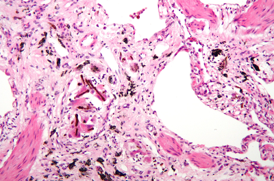 A high magnification micrograph with a hematoxylin and eosin stain coloring of a lung biopsy of an asbestosis patient, showing characteristic ferruginous bodies and interstitial fibrosis. asbestosis, pneumoconiosis, alveoli, alveolus, microscope, reading, physical examination, bronchus, bronchioli