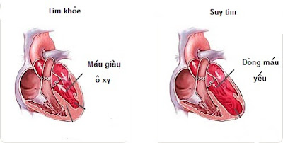  Biến chứng sau nhồi máu cơ tim