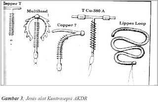 HEALTHY CAU S KONTRASEPSI IMFLAN AKBK IUD  AKDR KONTAP